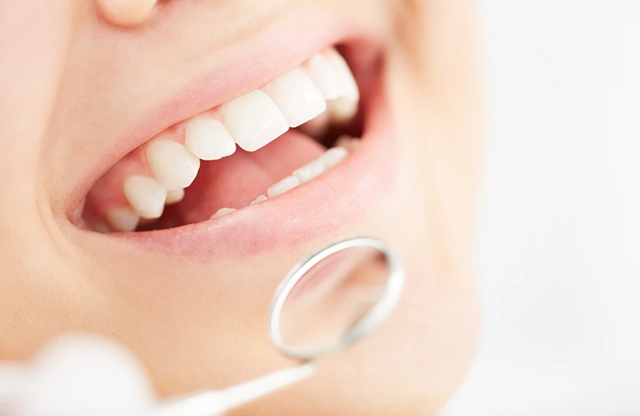 Close-up of a patient's whitened teeth during a dental check