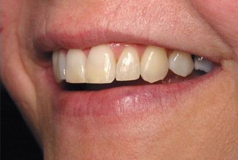 Close-up of a smiling person's mouth showing their upper front teeth, which are clean and slightly yellowish with natural texture.