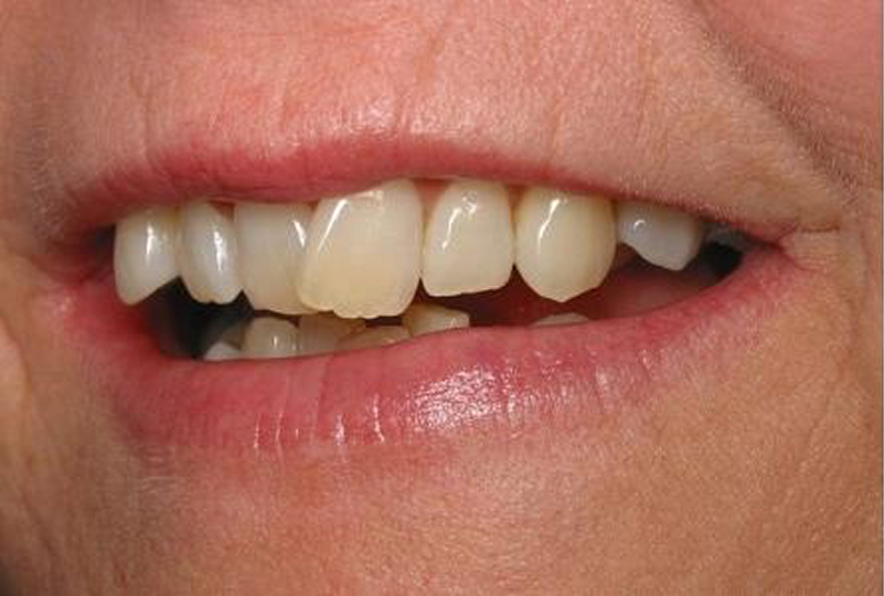 Close-up of a person's mouth showing uneven, discolored teeth with gaps and some misalignment.
