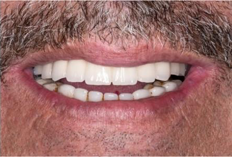 Close-up of a patient smile after upper dental implants at Bella Dental