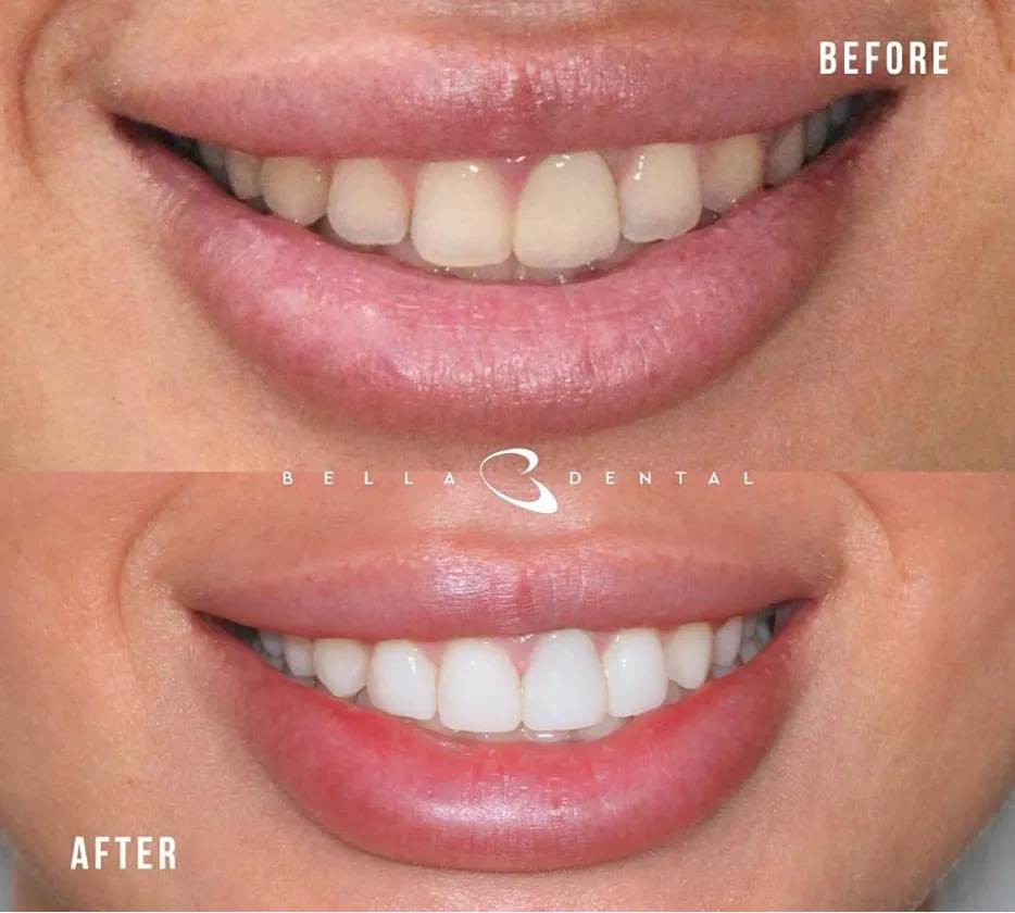 Close-up comparison of a person's smile before and after dental treatment, showing noticeable whitening and more even teeth alignment in the after image.