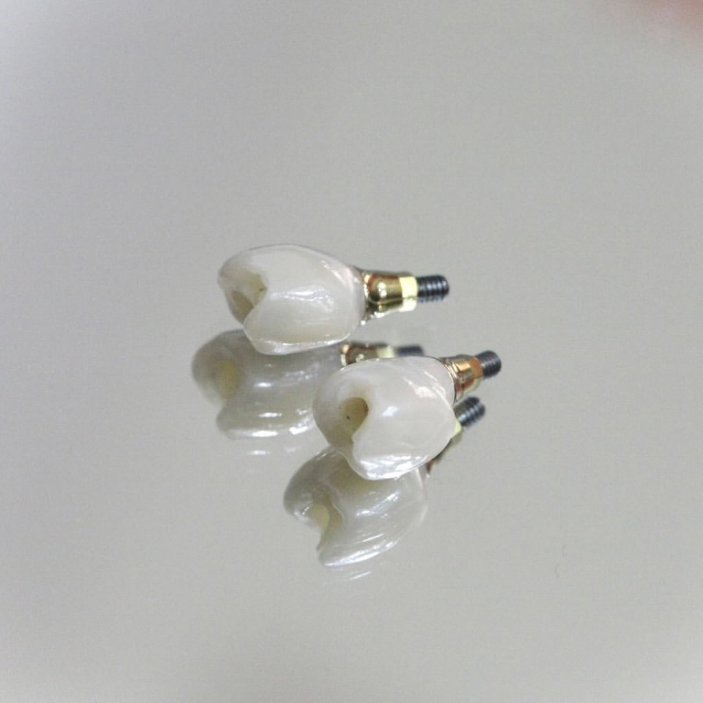 Two ceramic implant crowns on their abutments